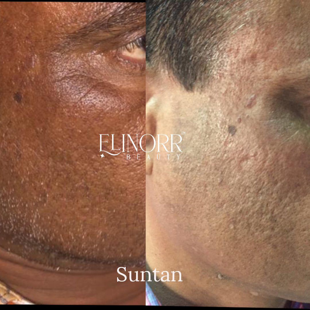 Elinorr Beauty Brightening Serum For Pigmentation &amp; Dark Spots With Kojic Acid + Alpha Arbutin - Elinorr